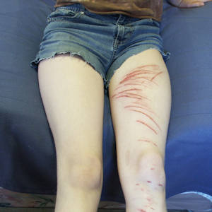 barbed wire injury horse riding accident